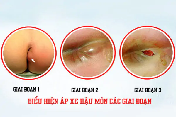 Hình ảnh áp xe hậu môn