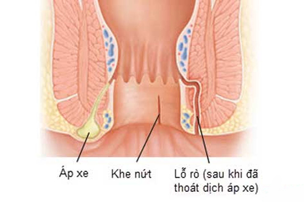 Áp xe hậu môn