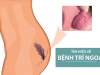 Dấu hiệu bệnh trĩ, cách điều trị