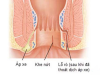 Áp xe hậu môn