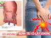 Bệnh trĩ có lây không, nguy hiểm gây ảnh hưởng sinh sản, tái phát không?