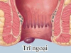 Chữa Trĩ Ngoại