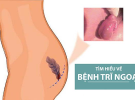 Dấu hiệu bệnh trĩ, cách điều trị