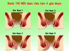 Bệnh trĩ là gì? Nguyên nhân, dấu hiệu nhận biết, thói quen gây trĩ