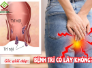 Bệnh trĩ có lây không, nguy hiểm gây ảnh hưởng sinh sản, tái phát không?