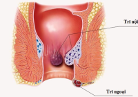 Dấu hiệu bệnh trĩ 