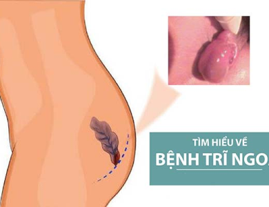 Dấu hiệu bệnh trĩ, cách điều trị