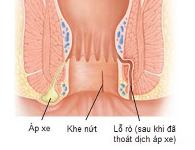 Áp xe hậu môn