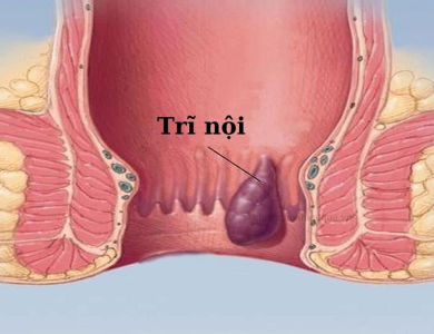 Chữa Trĩ Nội