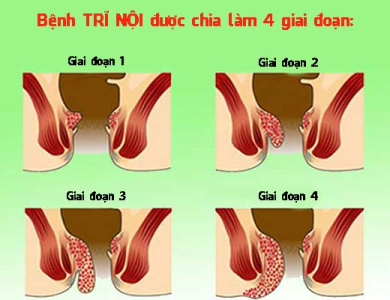 Bệnh trĩ là gì? Nguyên nhân, dấu hiệu nhận biết, thói quen gây trĩ