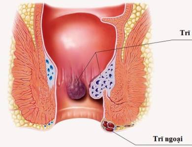Dấu hiệu bệnh trĩ 