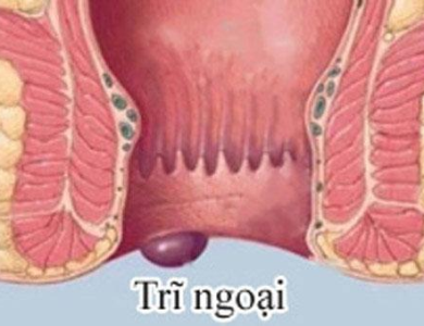 Chữa Trĩ Ngoại