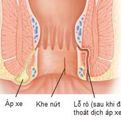 Áp xe hậu môn