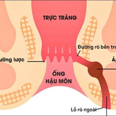 Rò hậu môn