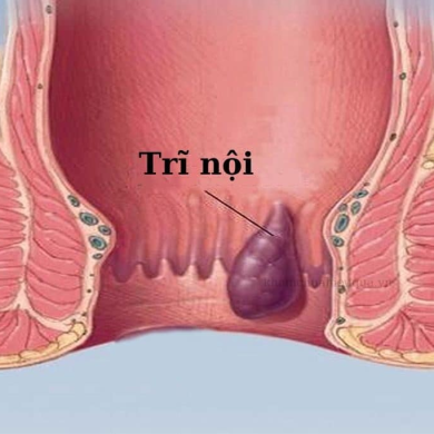 Chữa Trĩ Nội