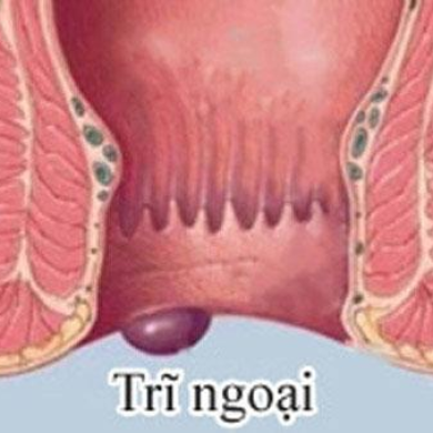 Chữa Trĩ Ngoại