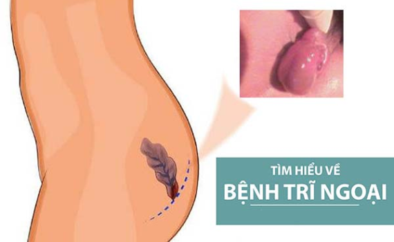 Dấu hiệu bệnh trĩ, cách điều trị