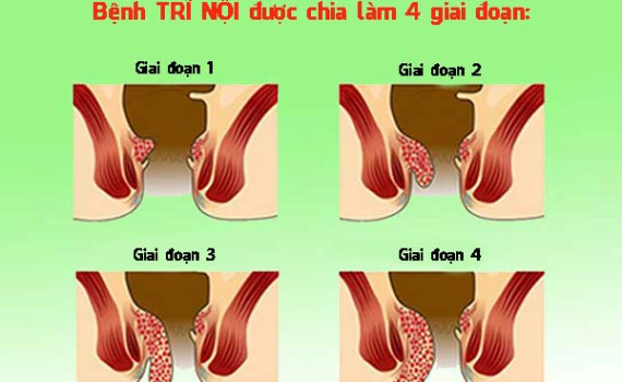 Bệnh trĩ là gì? Nguyên nhân, dấu hiệu nhận biết, thói quen gây trĩ