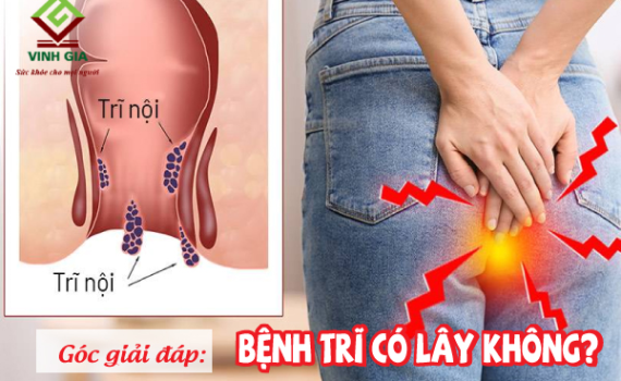 Bệnh trĩ có lây không, nguy hiểm gây ảnh hưởng sinh sản, tái phát không?